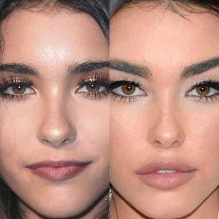 celebrities before and after lip fillers