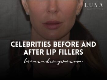 celebrities before and after lip fillers