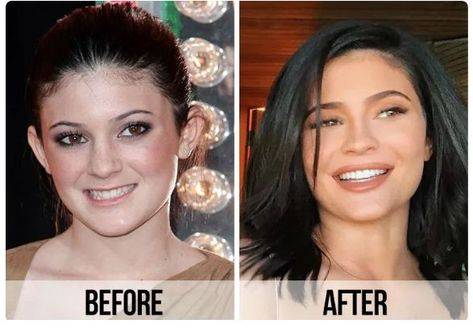 celebrities before and after lip fillers