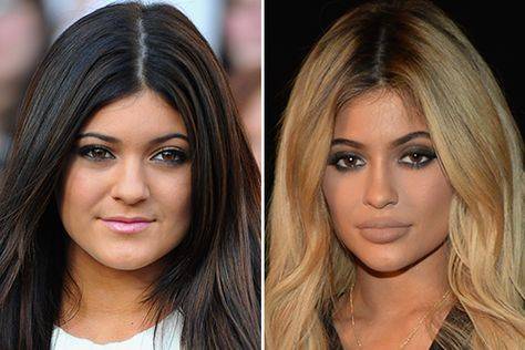 celebrities before and after lip fillers