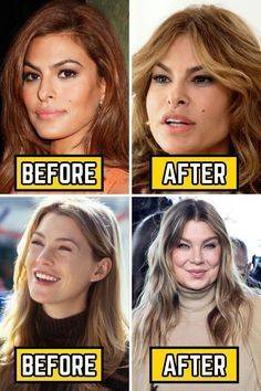 celebrities before and after lip fillers