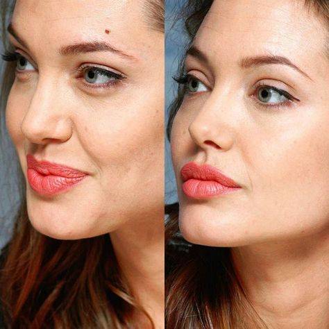 celebrities before and after lip fillers