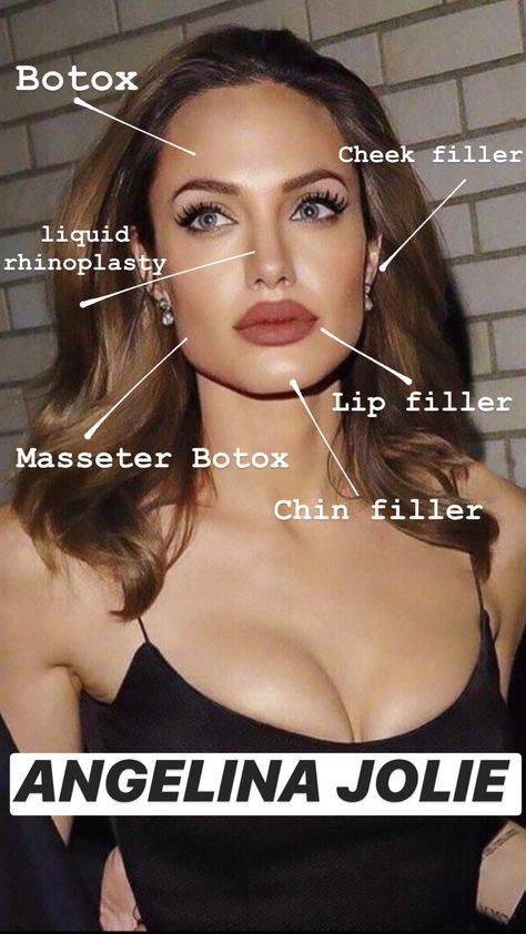 celebrities before and after lip fillers