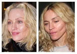 Celebrities Who Have Had a Thread Lift