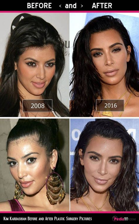 Celebrities Who Have Had a Thread Lift