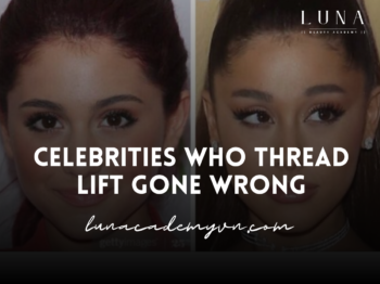 Celebrities Who Thread Lift Gone Wrong