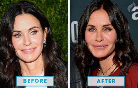 Celebrities with Botox Gone Wrong