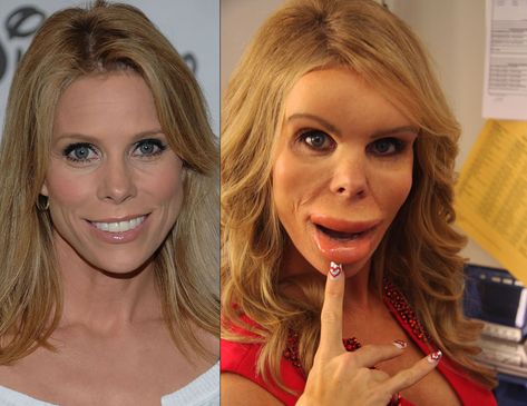 Celebrities with Botox Gone Wrong