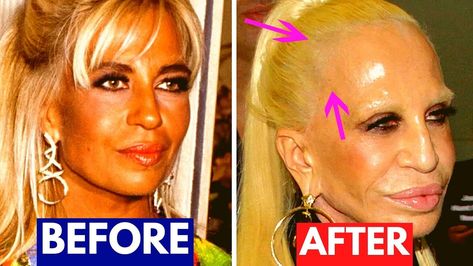 Celebrities with Botox Gone Wrong