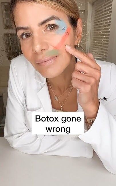 Celebrities with Botox Gone Wrong