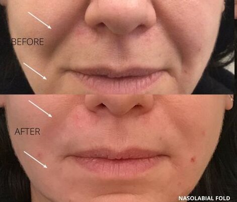 What Are Dermal Fillers and Why Do Celebrities Use Them?