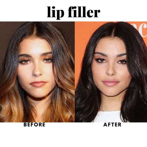 Celebrities with Lip Fillers: Star-Approved Pouts