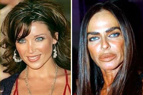 Celebrities with Too Much Botox