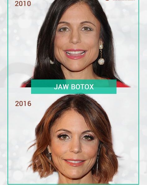 Celebrities with Too Much Botox