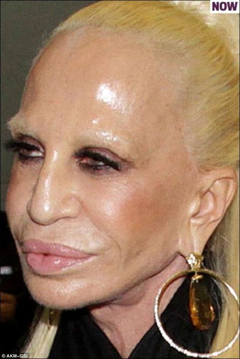 Celebrities with Too Much Botox