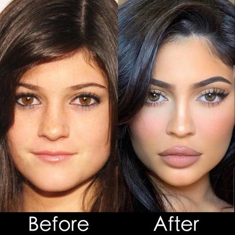 Celebrities with Too Much Botox