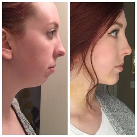 Celebrity Chin Filler Before and After