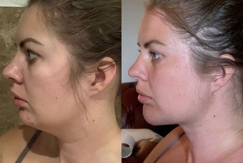 Celebrity Chin Filler Before and After