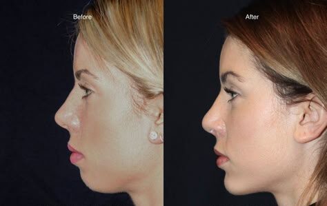 Celebrity Chin Filler Before and After