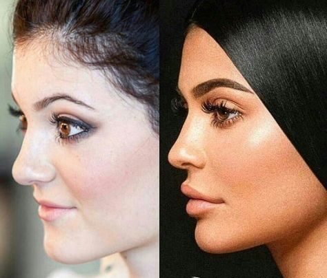 Celebrity Chin Filler Before and After