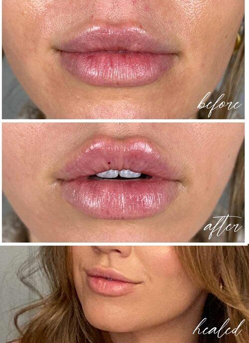 celebrity lip fillers gone wrong