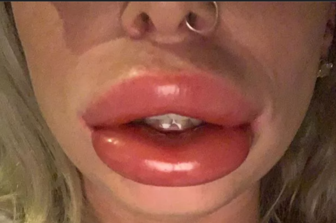 celebrity lip fillers gone wrong