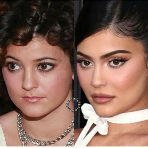 celebrity lip fillers gone wrong