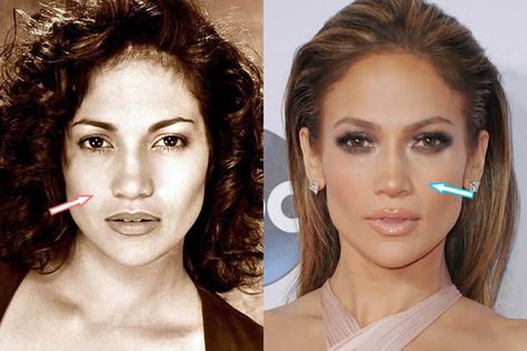 celebs with chin filler