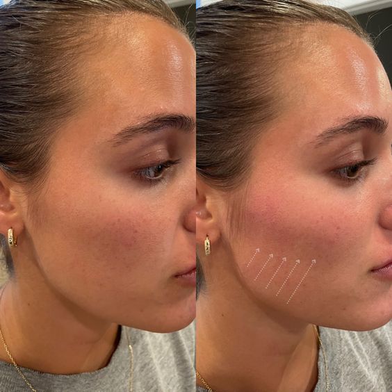 Cheek Bone Filler result