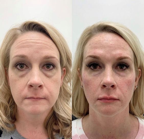 Cheek Filler Before and After 