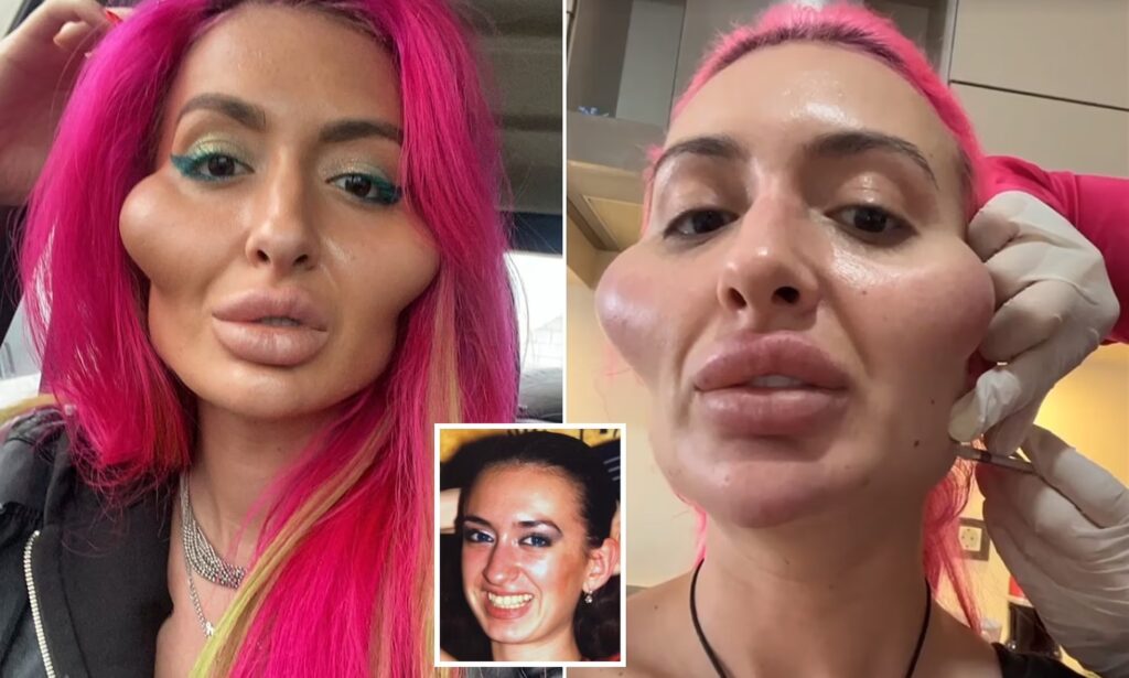 Cheek Filler Gone Wrong 