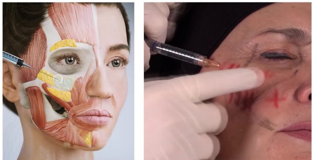 Cheek filler injection technique before procedure