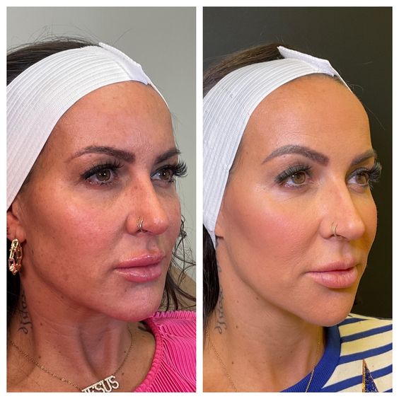 Cheek Filler Swelling Before and After