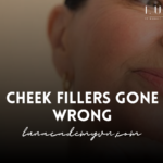 Cheek Fillers Gone Wrong: A Cautionary Tale for Beauty