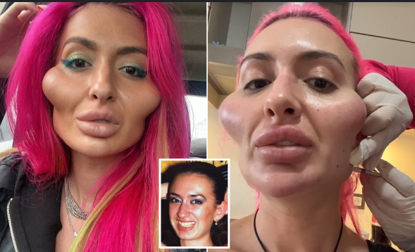 Cheek Fillers Gone Wrong: A Cautionary Tale for Beauty