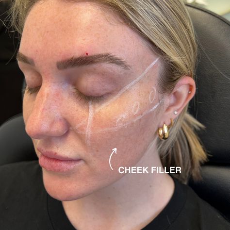 Cheek Fillers Gone Wrong: A Cautionary Tale for Beauty