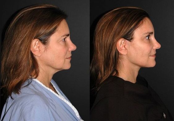 Cheek Fillers Help Lift Jowls