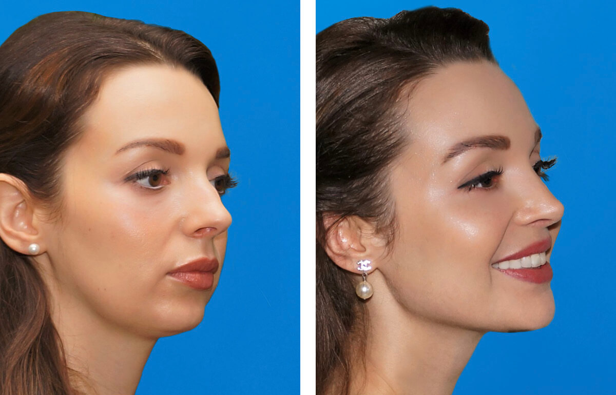 Cheek Implants Before and After