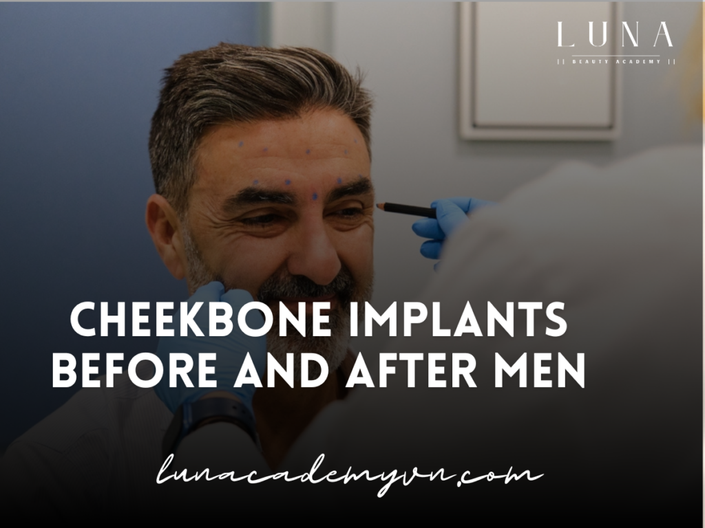 Cheekbone implants before and after men