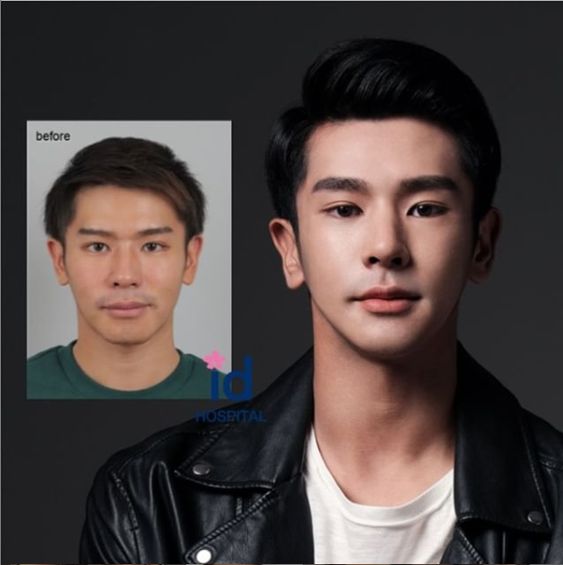 Cheekbone Implants Male: Before and After