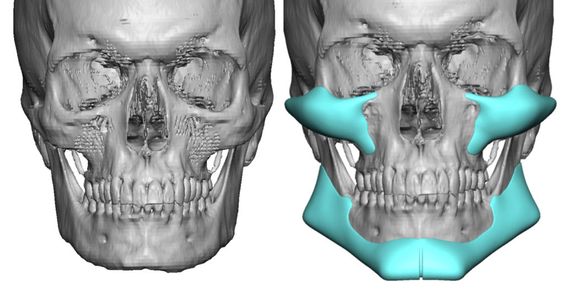 Cheekbone Implants Male