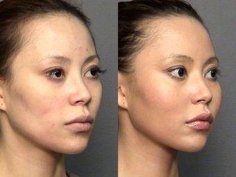 Cheekbone Implants reusult