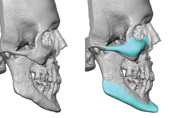 Cheekbone Implants