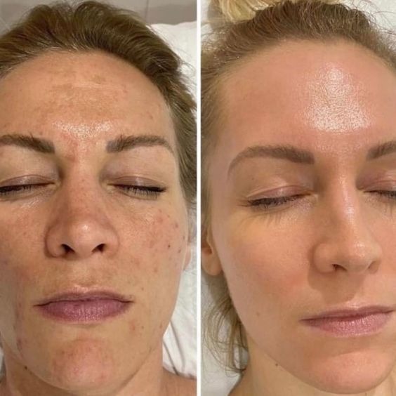 Chemical Peel Treatment