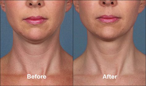 Chin Botox Gone Wrong: Understanding the Risks and Benefits