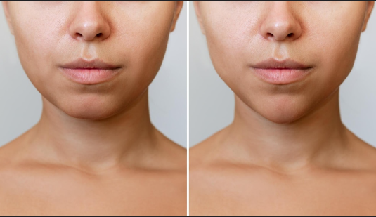 Chin Botox Gone Wrong: Understanding the Risks and Benefits