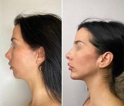 Chin Filler Pain: How to Minimize Discomfort