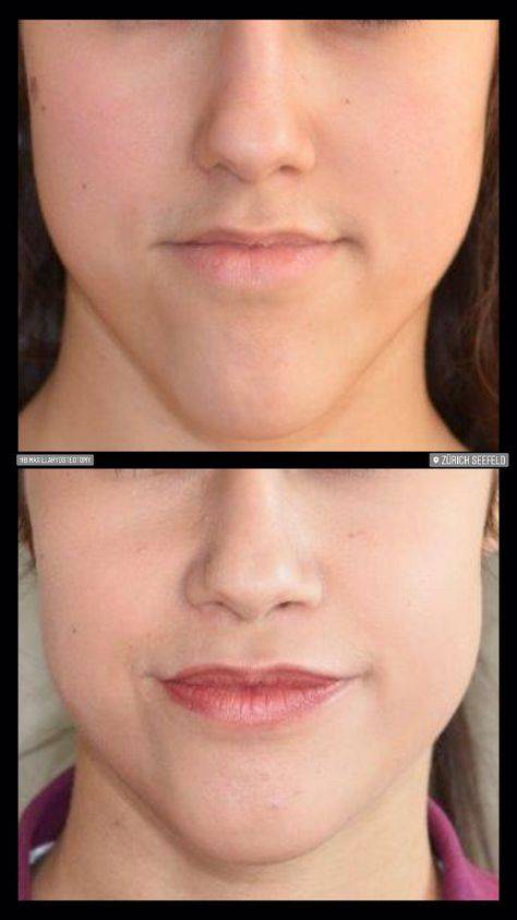 chin reduction surgery price