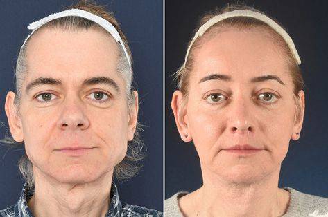 chin reduction surgery price