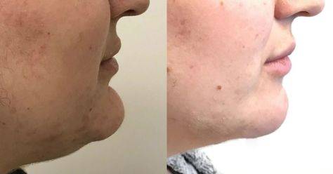 chin reduction surgery price